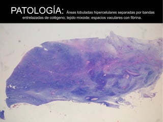 PATOLOGÍA: Áreas lobuladas hipercelulares separadas por bandas
entrelazadas de colégeno; tejido mixoide; espacios vaculares con fibrina.
 