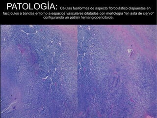 PATOLOGÍA: Células fusiformes de aspecto fibroblástico dispuestas en
fascículos o bandas entorno a espacios vasculares dilatados con morfología ''en asta de ciervo''
configurando un patrón hemangiopericitoide.
 