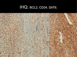 IHQ: BCL2. CD34. SAT6.
 