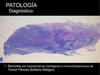 PATOLOGÍA
Diagnóstico:
● Sarcoma con características histológicas e inmunohistoquímicas de
Tumor Fibroso Solitario Maligno.
 