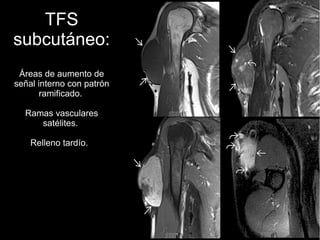 TFS
subcutáneo:
Áreas de aumento de
señal interno con patrón
ramificado.
Ramas vasculares
satélites.
Relleno tardío.
 