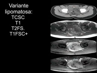 Variante
lipomatosa:
TCSC
T1
T2FS.
T1FSC+
 