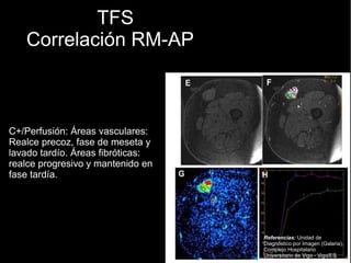 TFS
Correlación RM-AP
C+/Perfusión: Áreas vasculares:
Realce precoz, fase de meseta y
lavado tardío. Áreas fibróticas:
realce progresivo y mantenido en
fase tardía.
Referencias: Unidad de
Diagnóstico por Imagen (Galaria),
Complejo Hospitalario
Universitario de Vigo - Vigo/ES
 