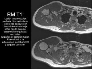 RM T1:
Lesión intramuscular,
ovalada, bien delimitada,
isointensa aunque con
áreas internas de baja
señal (tejido mixoide,
degeneración quística,
necrosis).
Expande el pectoral mayor.
Proximidad a la
articulación glenohumeral
y paquete vascular.
 