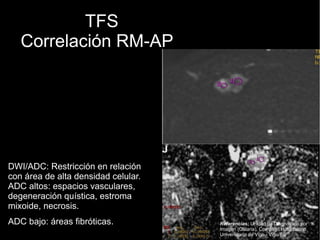 TFS
Correlación RM-AP
DWI/ADC: Restricción en relación
con área de alta densidad celular.
ADC altos: espacios vasculares,
degeneración quística, estroma
mixoide, necrosis.
ADC bajo: áreas fibróticas. Referencias: Unidad de Diagnóstico por
Imagen (Galaria), Complejo Hospitalario
Universitario de Vigo - Vigo/ES
 