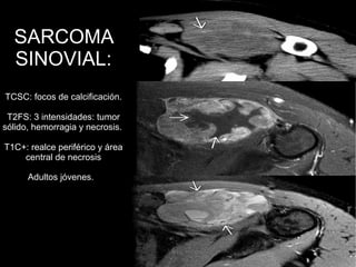 SARCOMA
SINOVIAL:
TCSC: focos de calcificación.
T2FS: 3 intensidades: tumor
sólido, hemorragia y necrosis.
T1C+: realce periférico y área
central de necrosis
Adultos jóvenes.
 