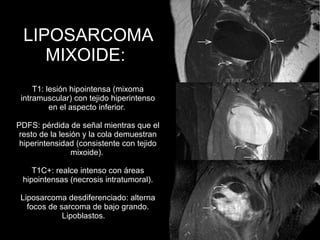 LIPOSARCOMA
MIXOIDE:
T1: lesión hipointensa (mixoma
intramuscular) con tejido hiperintenso
en el aspecto inferior.
PDFS: pérdida de señal mientras que el
resto de la lesión y la cola demuestran
hiperintensidad (consistente con tejido
mixoide).
T1C+: realce intenso con áreas
hipointensas (necrosis intratumoral).
Liposarcoma desdiferenciado: alterna
focos de sarcoma de bajo grando.
Lipoblastos.
 