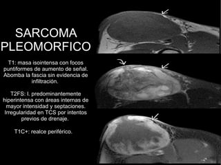SARCOMA
PLEOMORFICO
T1: masa isointensa con focos
puntiformes de aumento de señal.
Abomba la fascia sin evidencia de
infiltración.
T2FS: l. predominantemente
hiperintensa con áreas internas de
mayor intensidad y septaciones.
Irregularidad en TCS por intentos
previos de drenaje.
T1C+: realce periférico.
 