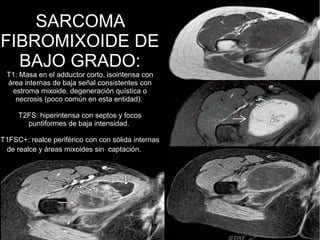 SARCOMA
FIBROMIXOIDE DE
BAJO GRADO:
T1: Masa en el adductor corto, isointensa con
área internas de baja señal consistentes con
estroma mixoide, degeneración quística o
necrosis (poco común en esta entidad).
T2FS: hiperintensa con septos y focos
puntiformes de baja intensidad.
T1FSC+: realce periférico con con sólida internas
de realce y áreas mixoides sin captación.
 
