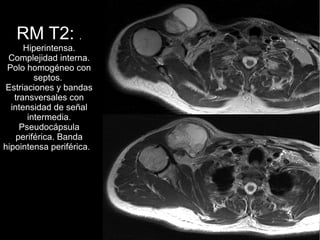 RM T2: .
Hiperintensa.
Complejidad interna.
Polo homogéneo con
septos.
Estriaciones y bandas
transversales con
intensidad de señal
intermedia.
Pseudocápsula
periférica. Banda
hipointensa periférica.
 
