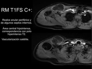 RM T1FS C+:
Realce anular periférico y
de algunos septos internos.
Área central hipointensa,
correspondencia con polo
hiperintenso T2.
Vascularización satélite.
 