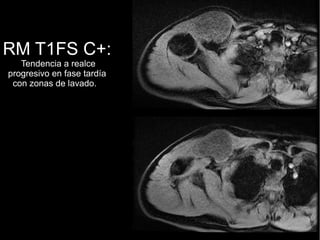 RM T1FS C+:
Tendencia a realce
progresivo en fase tardía
con zonas de lavado.
 