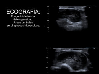 ECOGRAFÍA:
Ecogenicidad mixta.
Heterogeneidad.
Áreas centrales
serpinginosas hipoecoicas.
 