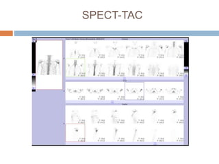 SPECT-TAC
 