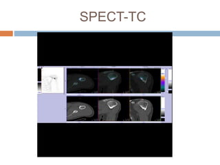 SPECT-TC
 