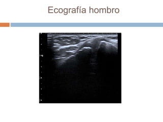 Ecografía hombro
 