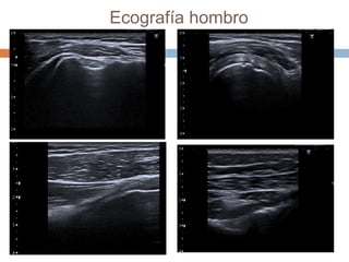 Ecografía hombro
 