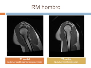 RM hombro
T1 sagital
Nido tumoral hipointenso/intermedio
T2 sagital
Nido tumoral hipointenso
 