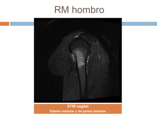 RM hombro
STIR sagital
Edema medular y de partes blandas
 