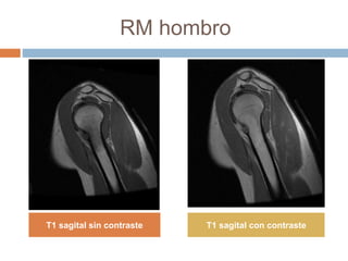 RM hombro
T1 sagital sin contraste T1 sagital con contraste
 