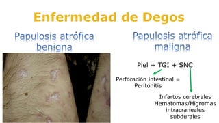 Piel + TGI + SNC
Perforación intestinal =
Peritonitis
Infartos cerebrales
Hematomas/Higromas
intracraneales
subdurales
 
