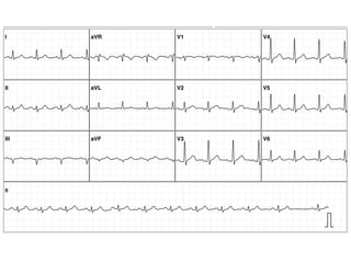 Informe:
Ritmo sinusal.Alteraciones inespecíficas de ST-T.
Síntomas:
Control
II
I aVR V1 V4
II aVL V2 V5
III aVF V3 V6
Resolución: 25 mm/seg 10 mm/mV Fecha recepción: 2010-08-11 17:10:02
Médico Solicitante:
[mV]
0 1 2 3 4
[sec]
0 1 2
 