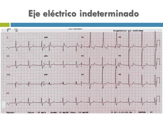 Eje eléctrico indeterminado
 