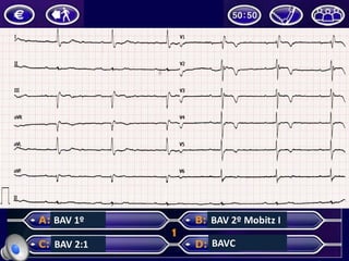 BAV	1º
BAV	2:1
BAV	2º	Mobitz	I
BAVC
 