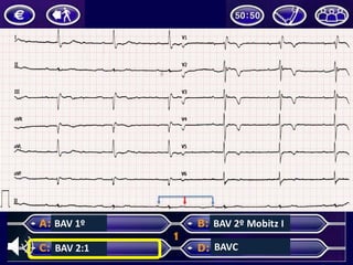BAV	1º
BAV	2:1
BAV	2º	Mobitz	I
BAVC
 