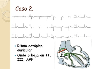 ECG. Casos prácticos | PPTX