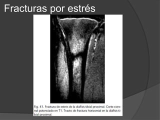 Fracturas por estrés
 
