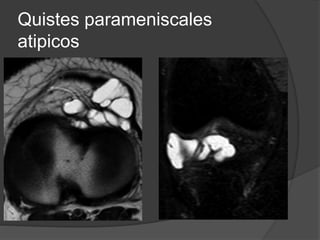 Quistes parameniscales
atipicos
 