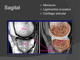 Sagital
 Meniscos
 Ligamentos cruzados
 Cartílago articular
 