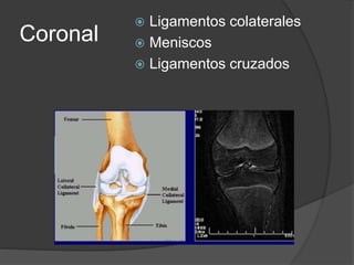 Coronal
 Ligamentos colaterales
 Meniscos
 Ligamentos cruzados
 