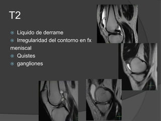 T2
 Liquido de derrame
 Irregularidad del contorno en fx
meniscal
 Quistes
 gangliones
 
