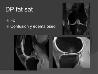 DP fat sat
 Fx
 Contusión y edema oseo
 