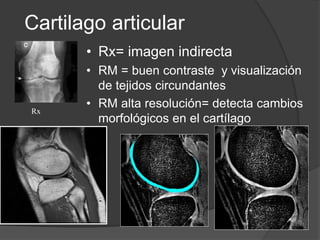 Rx
Cartilago articular
• Rx= imagen indirecta
• RM = buen contraste y visualización
de tejidos circundantes
• RM alta resolución= detecta cambios
morfológicos en el cartílago
 