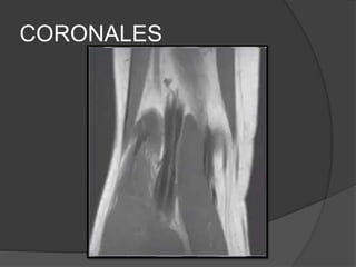 CORONALES
 
