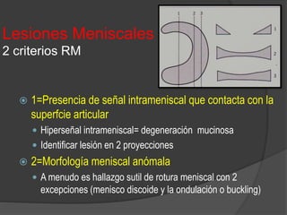 Lesiones Meniscales
2 criterios RM
 1=Presencia de señal intrameniscal que contacta con la
superfcie articular
 Hiperseñal intrameniscal= degeneración mucinosa
 Identificar lesión en 2 proyecciones
 2=Morfología meniscal anómala
 A menudo es hallazgo sutil de rotura meniscal con 2
excepciones (menisco discoide y la ondulación o buckling)
 