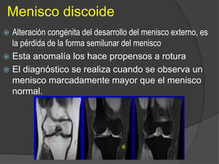 Menisco discoide
 Alteración congénita del desarrollo del menisco externo, es
la pérdida de la forma semilunar del menisco
 Esta anomalía los hace propensos a rotura
 El diagnóstico se realiza cuando se observa un
menisco marcadamente mayor que el menisco
normal.
 