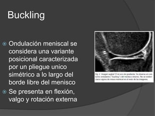 Buckling
 Ondulación meniscal se
considera una variante
posicional caracterizada
por un pliegue unico
simétrico a lo largo del
borde libre del menisco
 Se presenta en flexión,
valgo y rotación externa
 