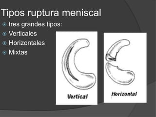 Tipos ruptura meniscal
 tres grandes tipos:
 Verticales
 Horizontales
 Mixtas
 