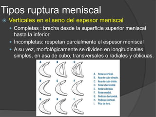 Tipos ruptura meniscal
 Verticales en el seno del espesor meniscal
 Completas : brecha desde la superficie superior meniscal
hasta la inferior
 Incompletas: respetan parcialmente el espesor meniscal
 A su vez, morfológicamente se dividen en longitudinales
simples, en asa de cubo, transversales o radiales y oblicuas.
 