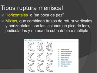Tipos ruptura meniscal
 Horizontales o “en boca de pez”
 Mixtas, que combinan trazos de rotura verticales
y horizontales; son las lesiones en pico de loro,
pediculadas y en asa de cubo doble o múltiple
 