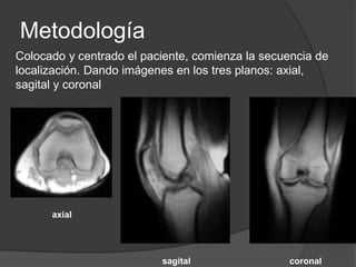 Metodología
Colocado y centrado el paciente, comienza la secuencia de
localización. Dando imágenes en los tres planos: axial,
sagital y coronal
axial
sagital coronal
 
