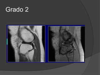 Grado 2
 