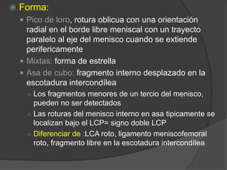  Forma:
 Pico de loro, rotura oblicua con una orientación
radial en el borde libre meniscal con un trayecto
paralelo al eje del menisco cuando se extiende
perifericamente
 Mixtas: forma de estrella
 Asa de cubo: fragmento interno desplazado en la
escotadura intercondílea
○ Los fragmentos menores de un tercio del menisco,
pueden no ser detectados
○ Las roturas del menisco interno en asa tipicamente se
localizan bajo el LCP= signo doble LCP
○ Diferenciar de :LCA roto, ligamento meniscofemoral
roto, fragmento libre en la escotadura intercondílea
 