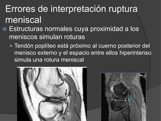Errores de interpretación ruptura
meniscal
 Estructuras normales cuya proximidad a los
meniscos simulan roturas
 Tendón poplíteo está próximo al cuerno posterior del
menisco externo y el espacio entre ellos hiperintenso
simula una rotura meniscal
 