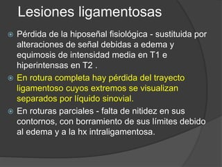 Lesiones ligamentosas
 Pérdida de la hiposeñal fisiológica - sustituida por
alteraciones de señal debidas a edema y
equimosis de intensidad media en T1 e
hiperintensas en T2 .
 En rotura completa hay pérdida del trayecto
ligamentoso cuyos extremos se visualizan
separados por líquido sinovial.
 En roturas parciales - falta de nitidez en sus
contornos, con borramiento de sus límites debido
al edema y a la hx intraligamentosa.
 