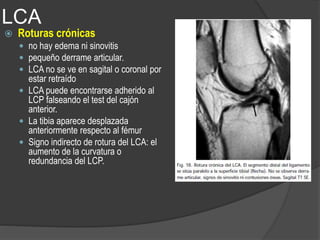 LCA
 Roturas crónicas
 no hay edema ni sinovitis
 pequeño derrame articular.
 LCA no se ve en sagital o coronal por
estar retraído
 LCA puede encontrarse adherido al
LCP falseando el test del cajón
anterior.
 La tibia aparece desplazada
anteriormente respecto al fémur
 Signo indirecto de rotura del LCA: el
aumento de la curvatura o
redundancia del LCP.
 